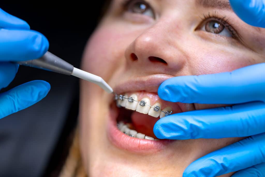 procedure-dentaire-pour-l-installation-des-bagues-classiques