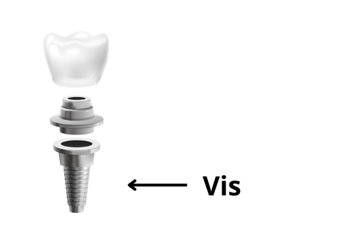 Vis implantaire en titane pour implant dentaire