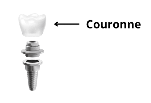 Couronne prothétique sur implant dentaire