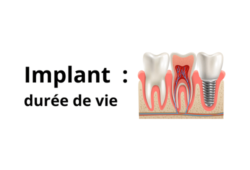 Durée de vie d'un implant dentaire : longévité et entretien au Cabinet Bontemps à Cergy