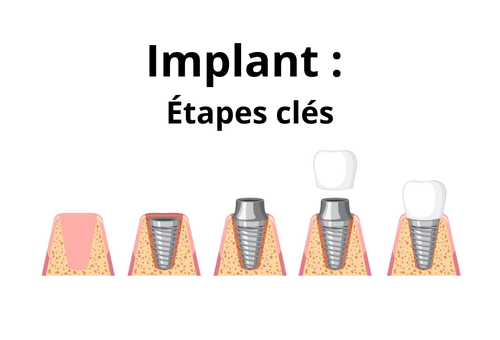 Comment se pose un implant dentaire : les 5 étapes chirurgicales expliquées — Cabinet Bontemps à Cergy