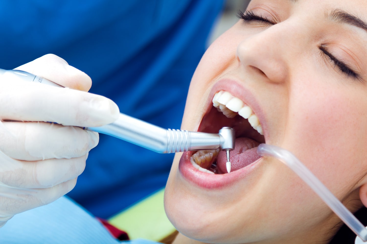 Dentiste réalisant un polissage professionnel sur une dent pour éliminer les colorations exogènes