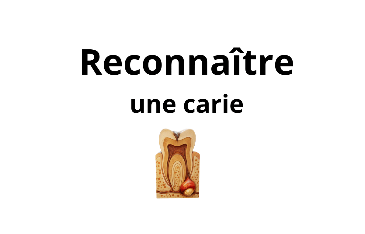 Comment reconnaître une carie débutante — Cabinet Dentaire Bontemps à Cergy