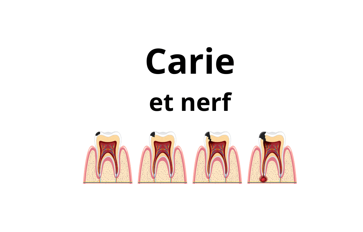 Carie qui touche le nerf : symptômes et traitements — Cabinet Dentaire Bontemps à Cergy