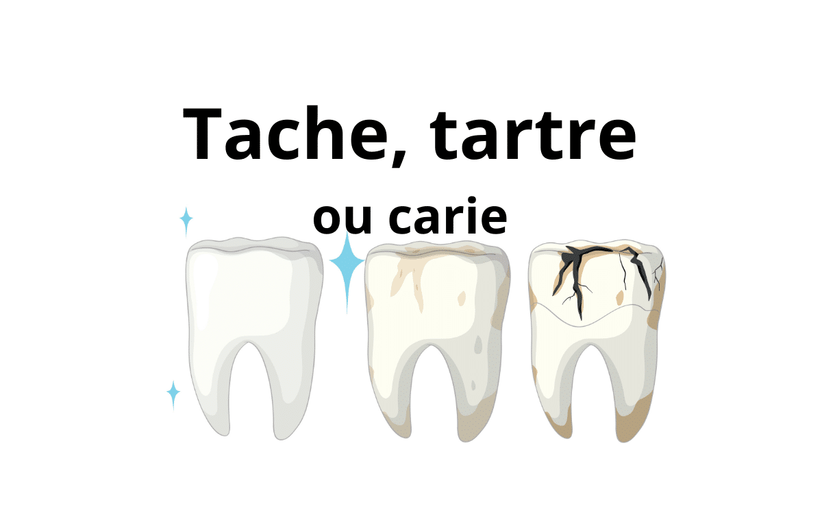 Tache noire, tartre ou carie : comment différencier — Cabinet Dentaire Bontemps à Cergy