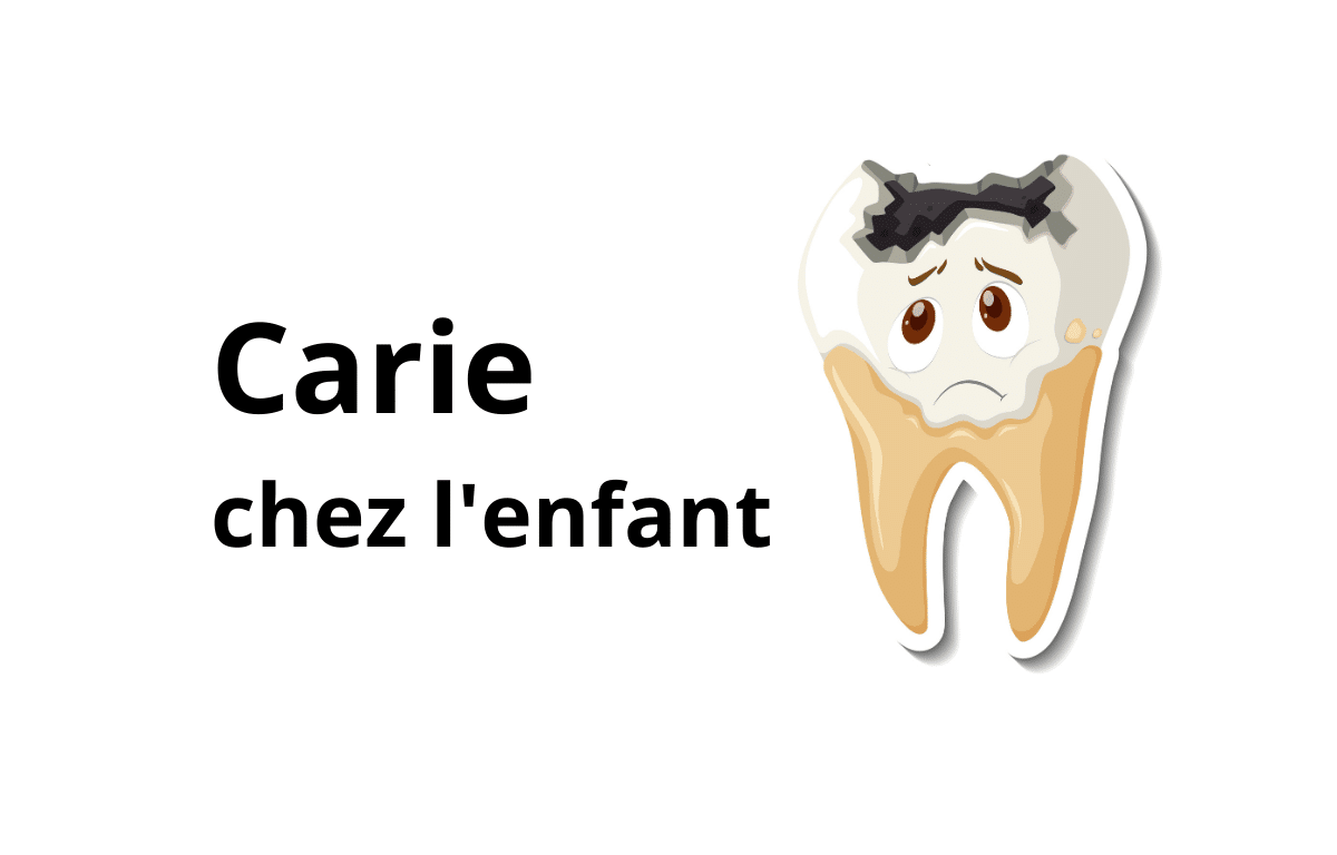 Carie chez l'enfant : que faire — Cabinet Dentaire Bontemps à Cergy