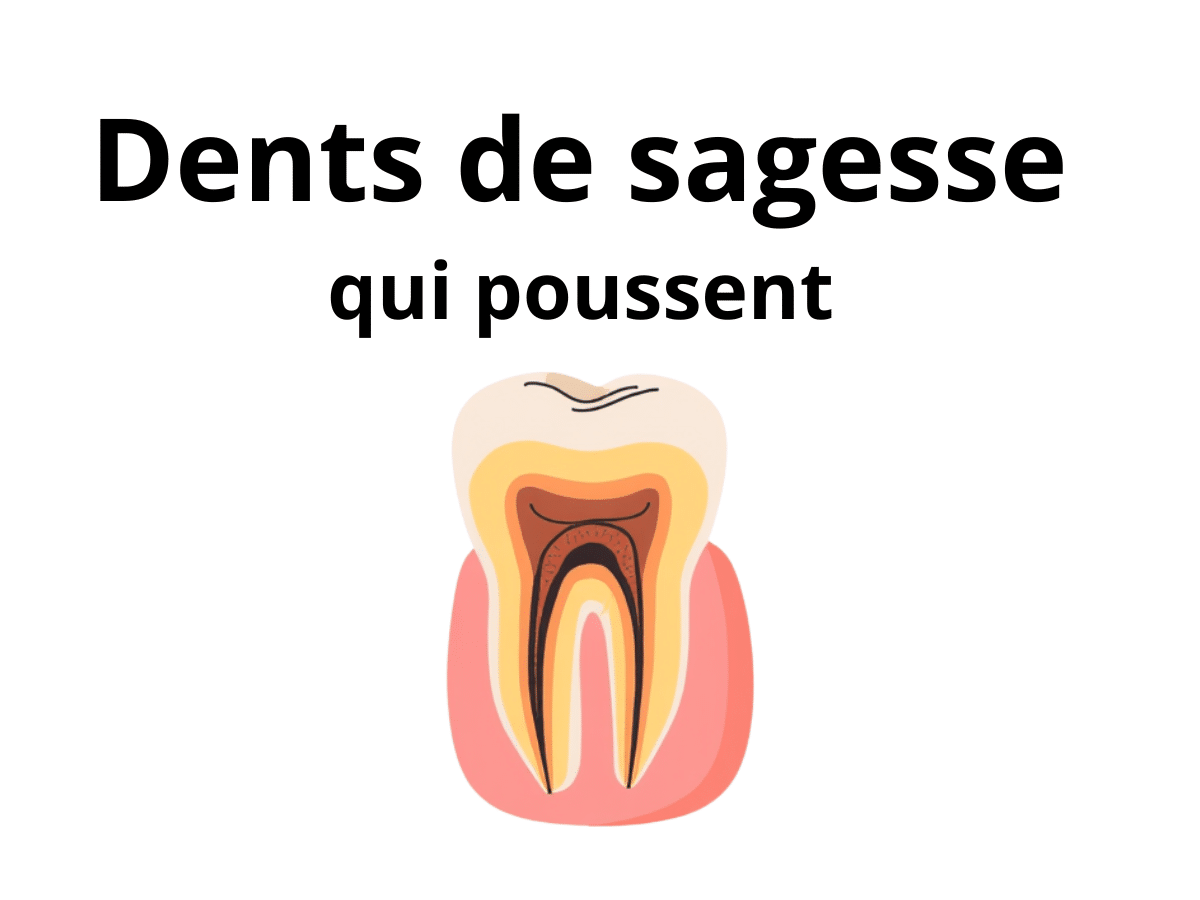 Dents de sagesse qui poussent : symptômes et signes d'alerte