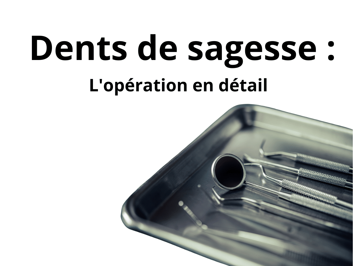 Extraction des dents de sagesse : déroulement de l'opération