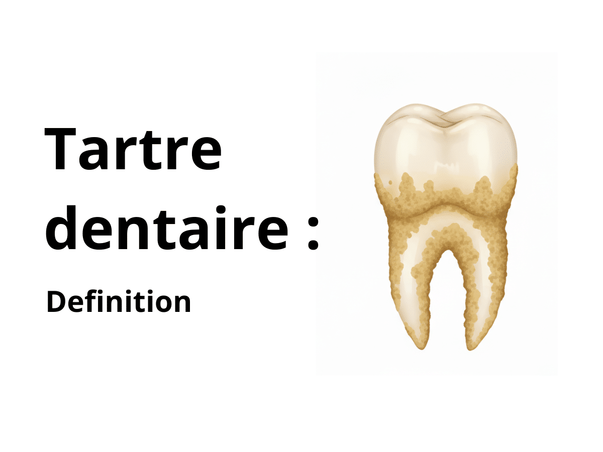 Tartre dentaire : c'est quoi exactement ?