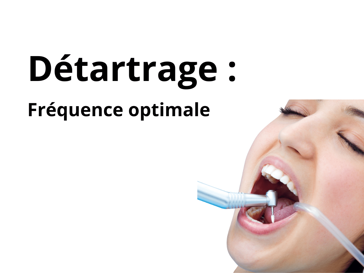Détartrage : tous les combien faut-il le faire ?