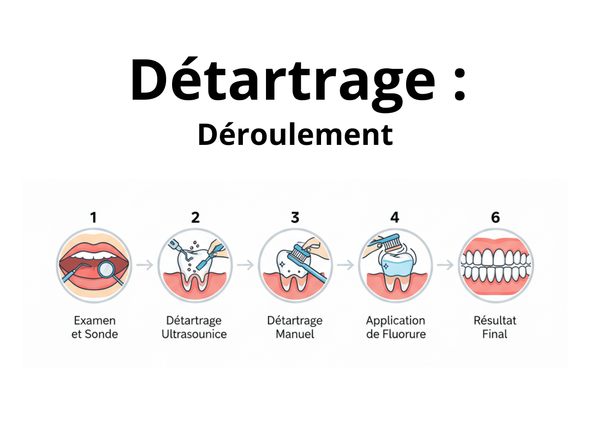 Combien de temps dure un détartrage et comment se déroule la séance ?