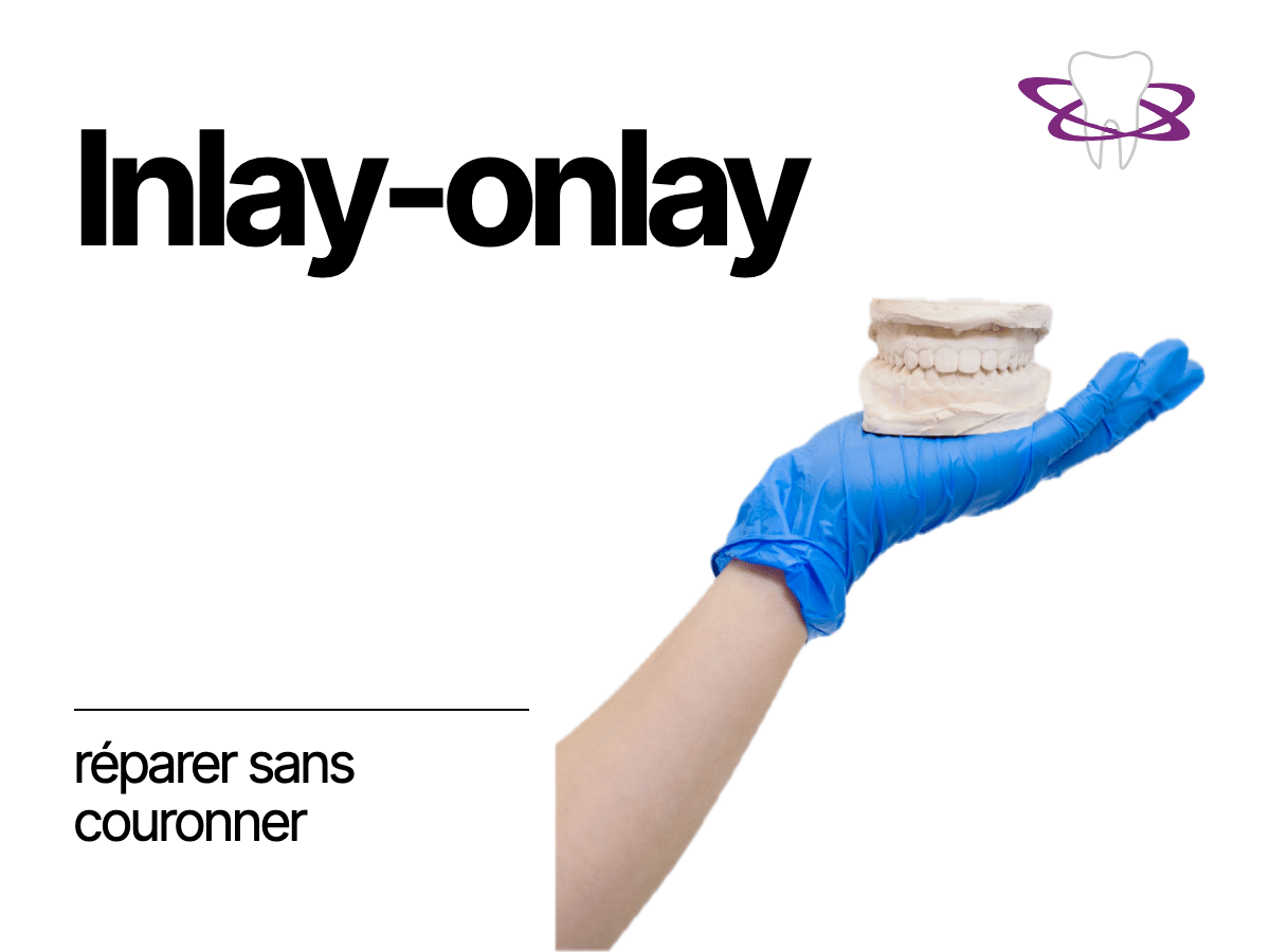Inlay-onlay : tout comprendre sur cette restauration - Cabinet Dentaire Bontemps
