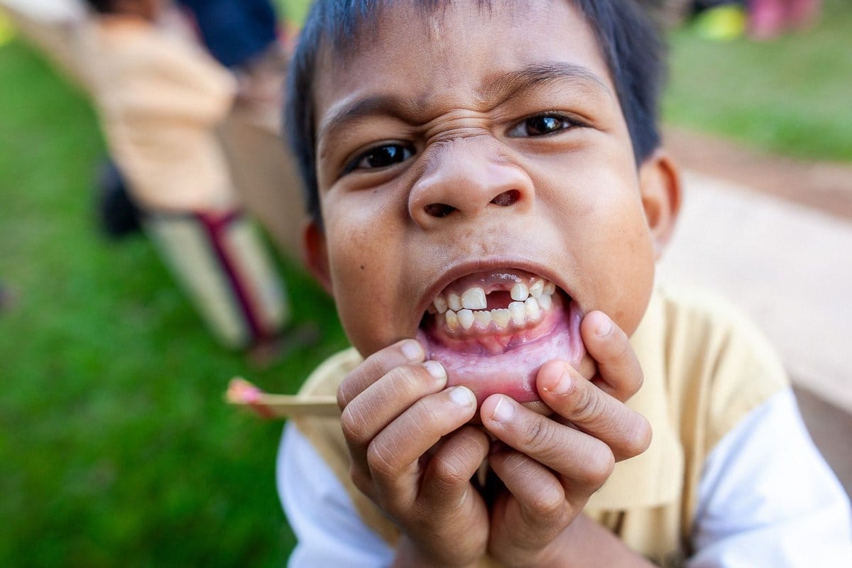 Enfant écartant sa lèvre pour montrer ses dents en cours de remplacement