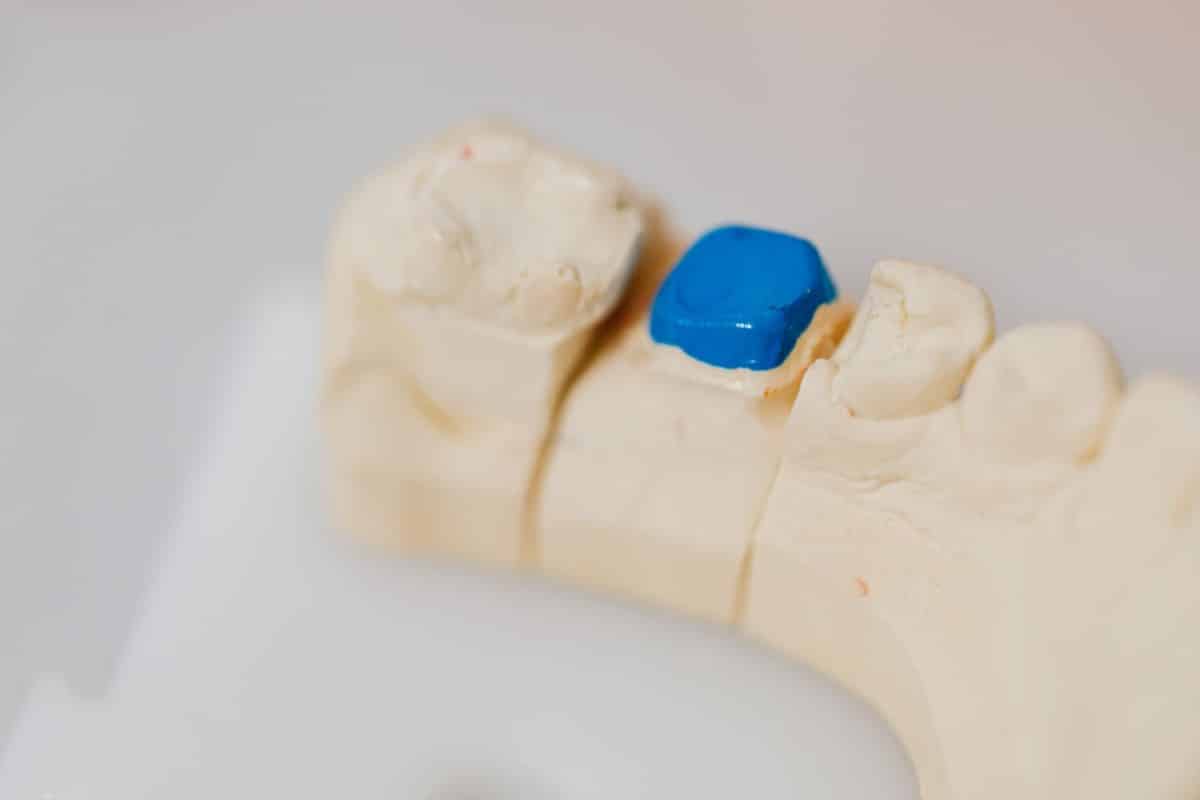 Restauration incrustée mise en place dans la cavité d'une molaire, sur modèle de travail