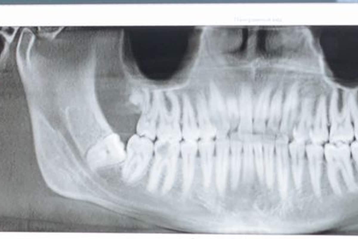 Radiographie panoramique dentaire affichée sur un écran de cabinet