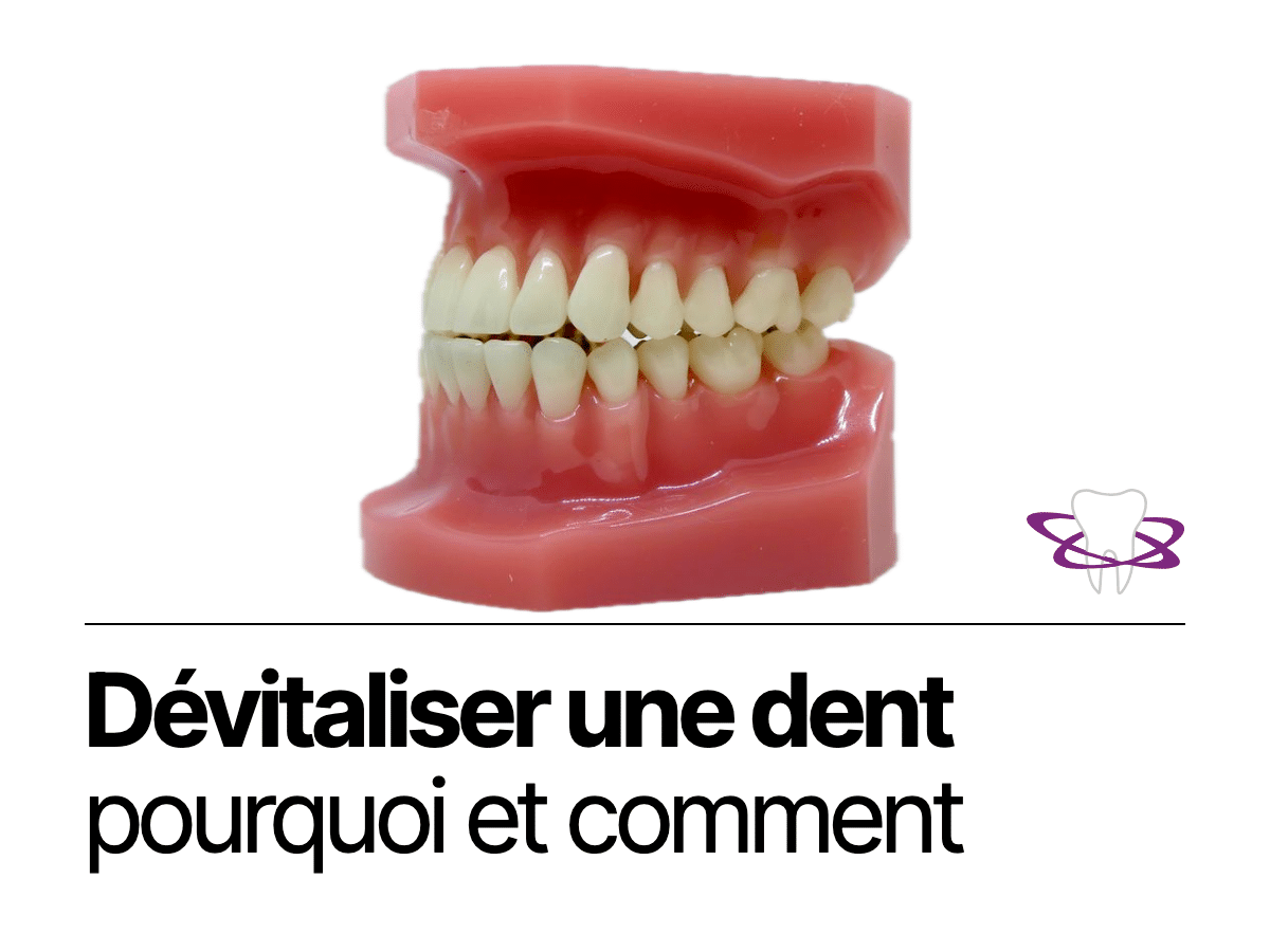 Dévitaliser une dent : pourquoi, comment et quelles suites - Cabinet Dentaire Bontemps