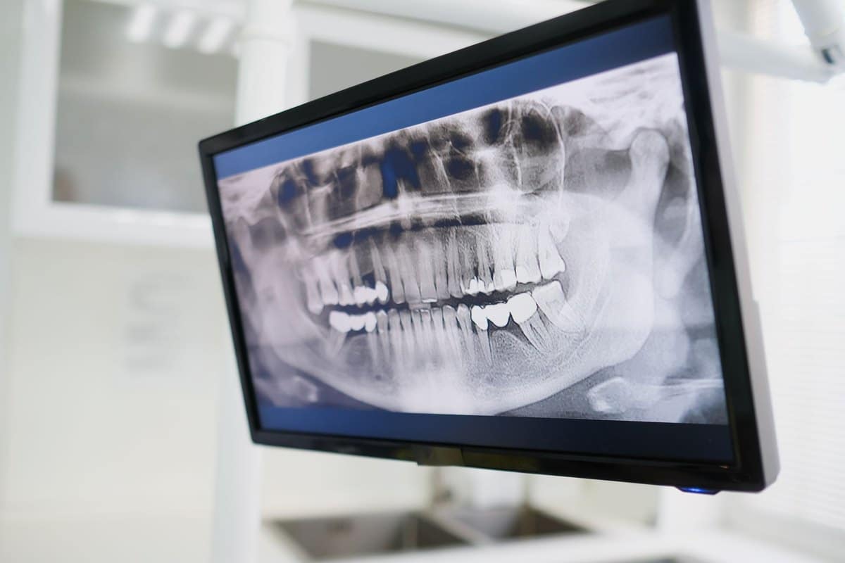Radiographie panoramique dentaire affichée sur un écran de cabinet