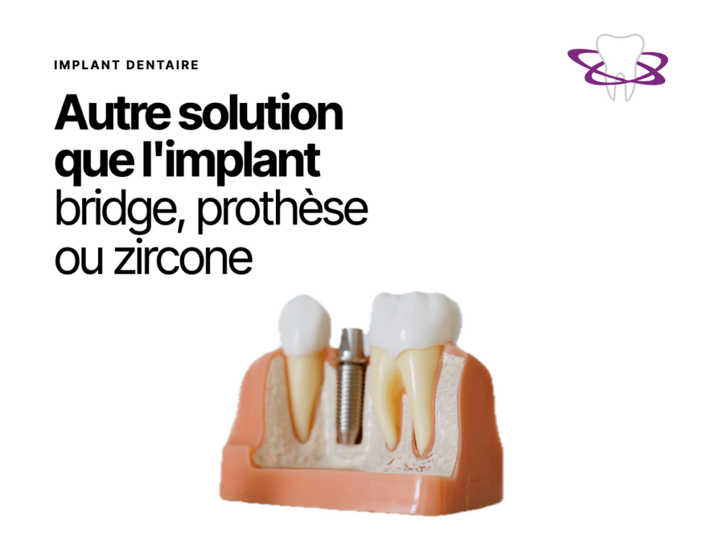 Autre solution que l'implant dentaire : bridge, prothèse, zircone, basale